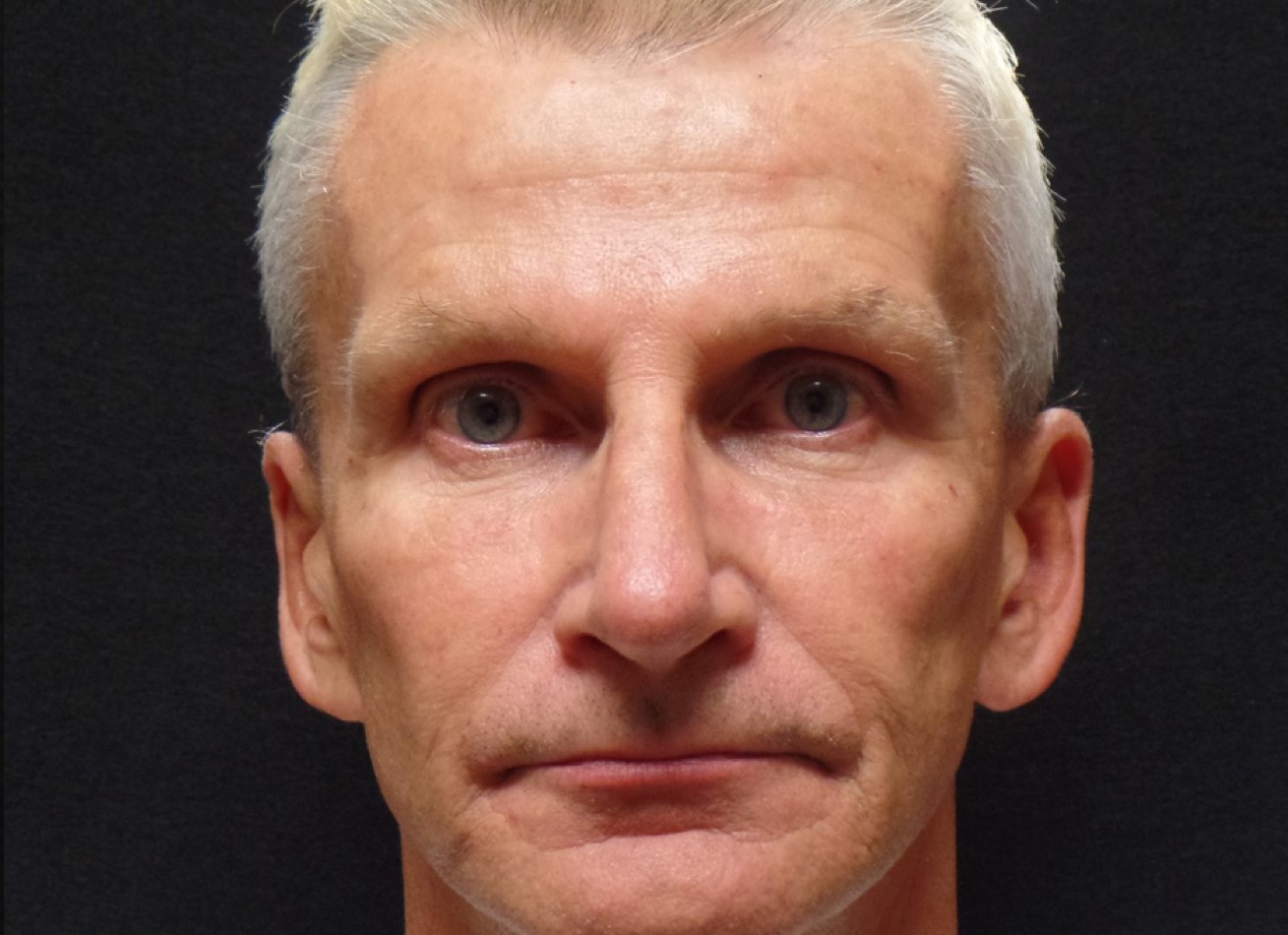 Patient #74935-1: IPL for Brown Spots After Image