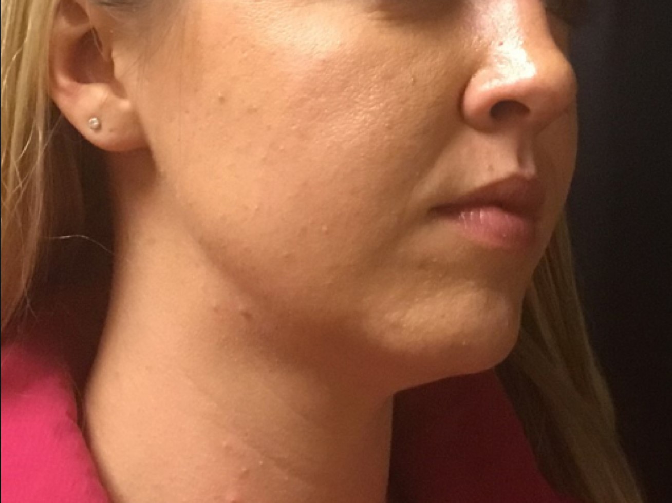 Patient #39130: Chemical Peel After Image