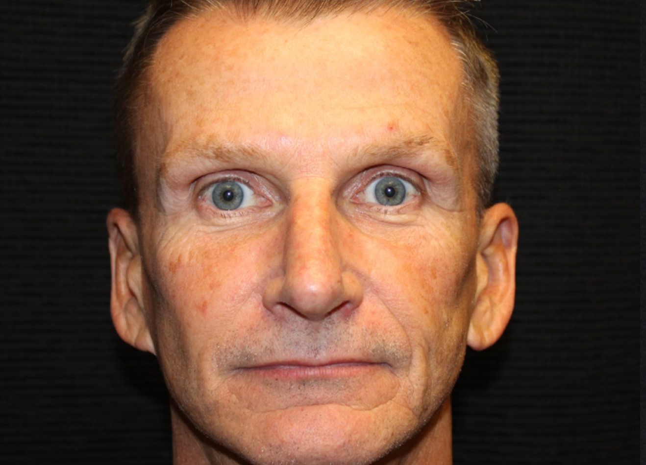 Patient #74935-1: IPL for Brown Spots Before Image