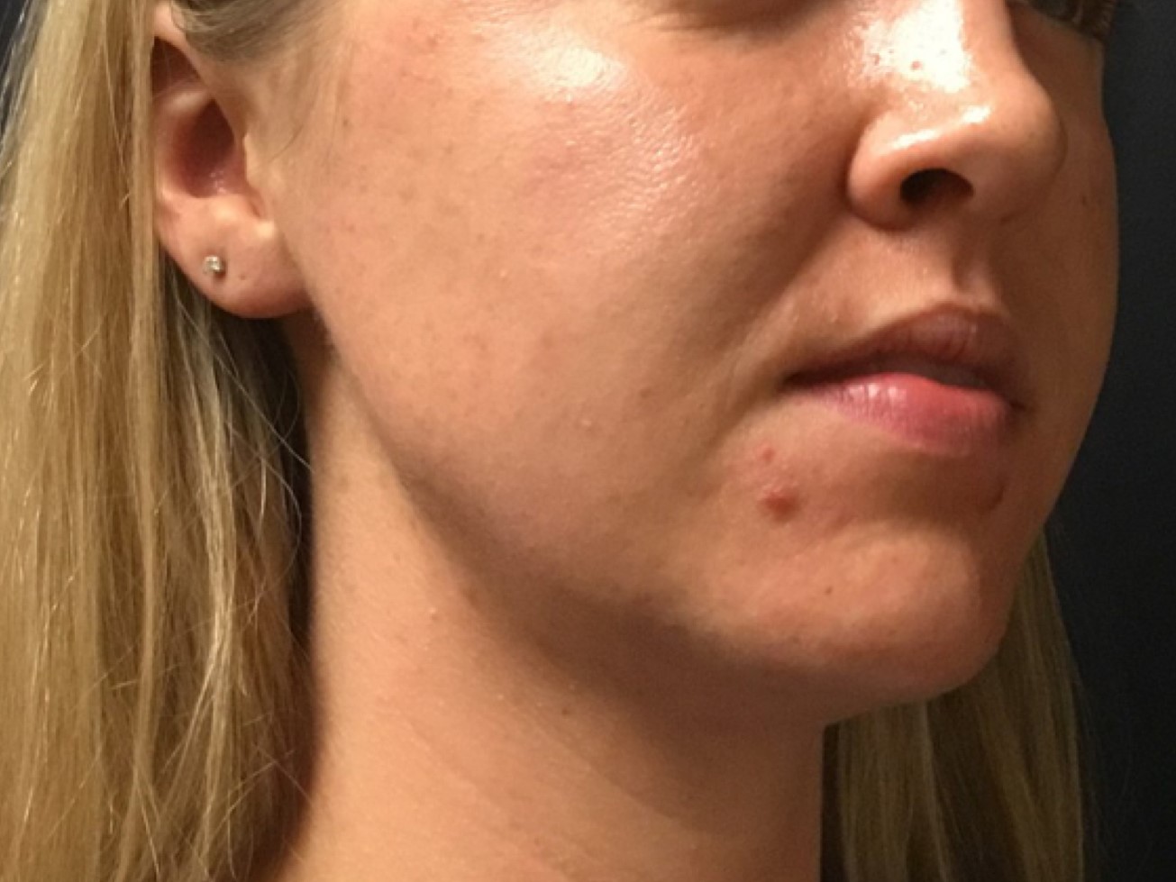 Patient #39130: Chemical Peel Before Image