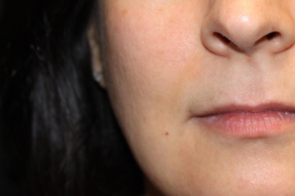 Patient #48319: Vollure After Image