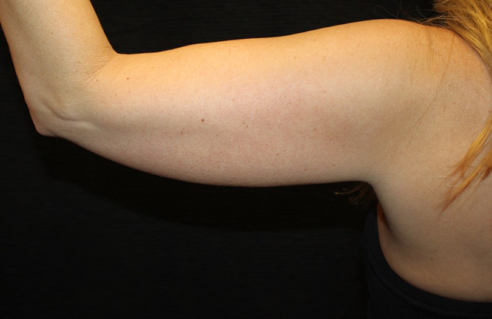 Patient #95479: CoolSculpting After Image