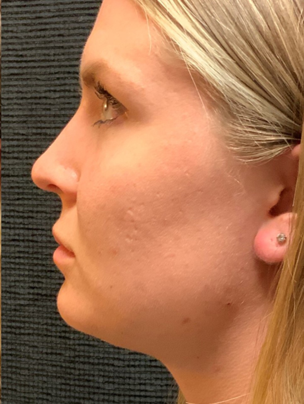 Patient #80222-2: Microneedling for Acne Scarring After Image