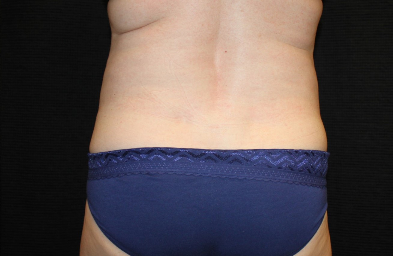 Patient #58820: CoolSculpting After Image