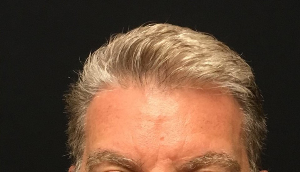 Patient #14502: Botox® After Image