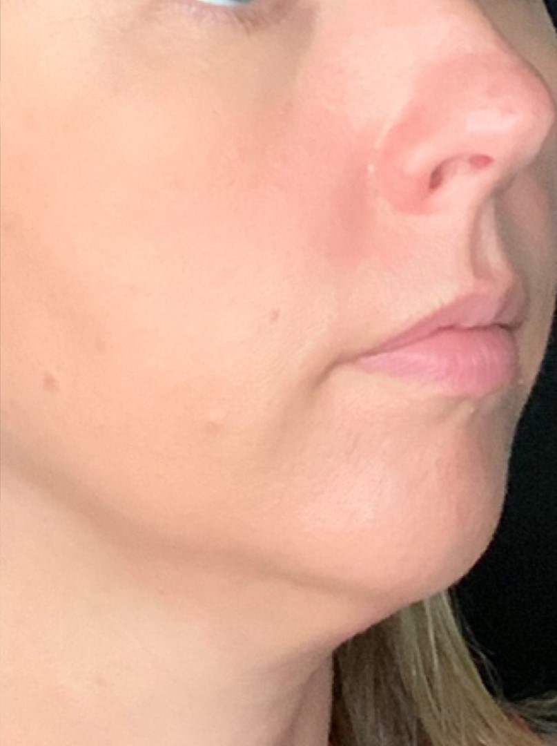 Patient #75111: 3 For Me Refresh After Image