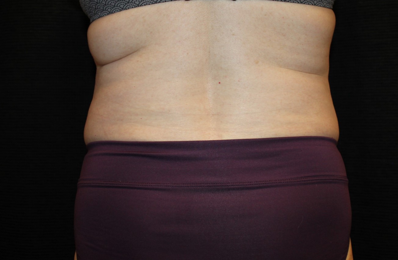 Patient #58820: CoolSculpting Before Image