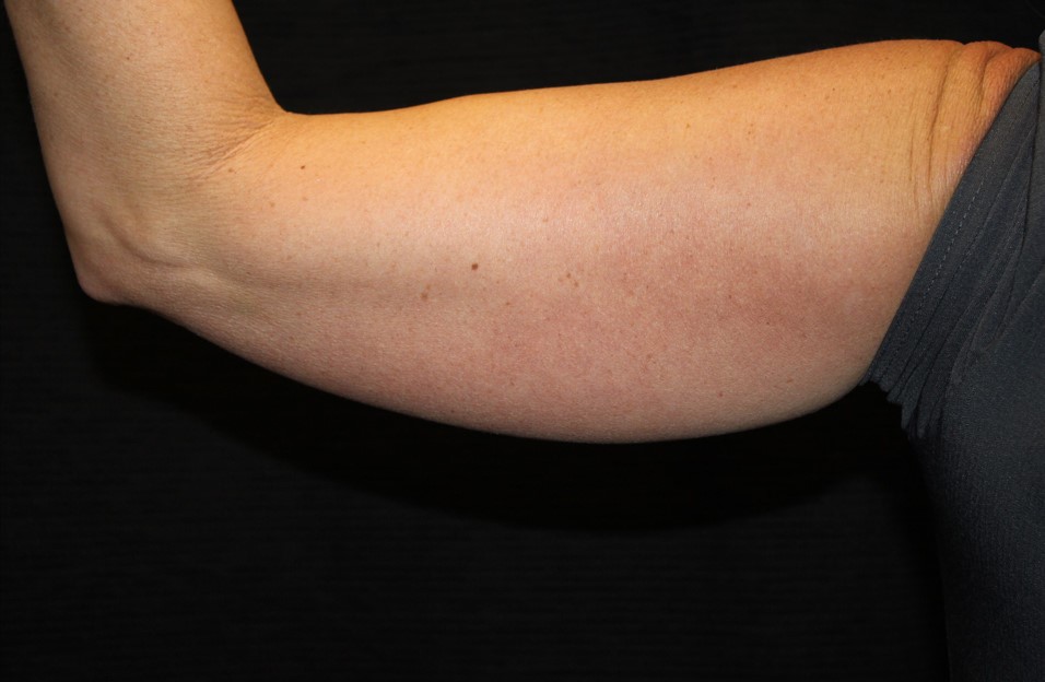 Patient #95479: CoolSculpting Before Image