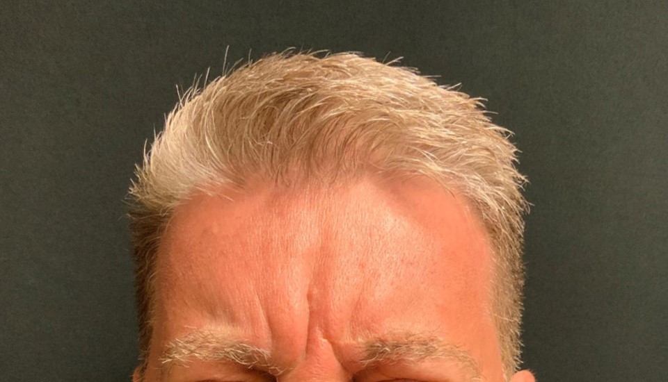 Patient #14502: Botox® Before Image