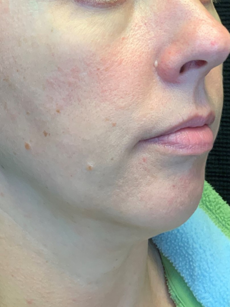 Patient #75111: 3 For Me Refresh Before Image