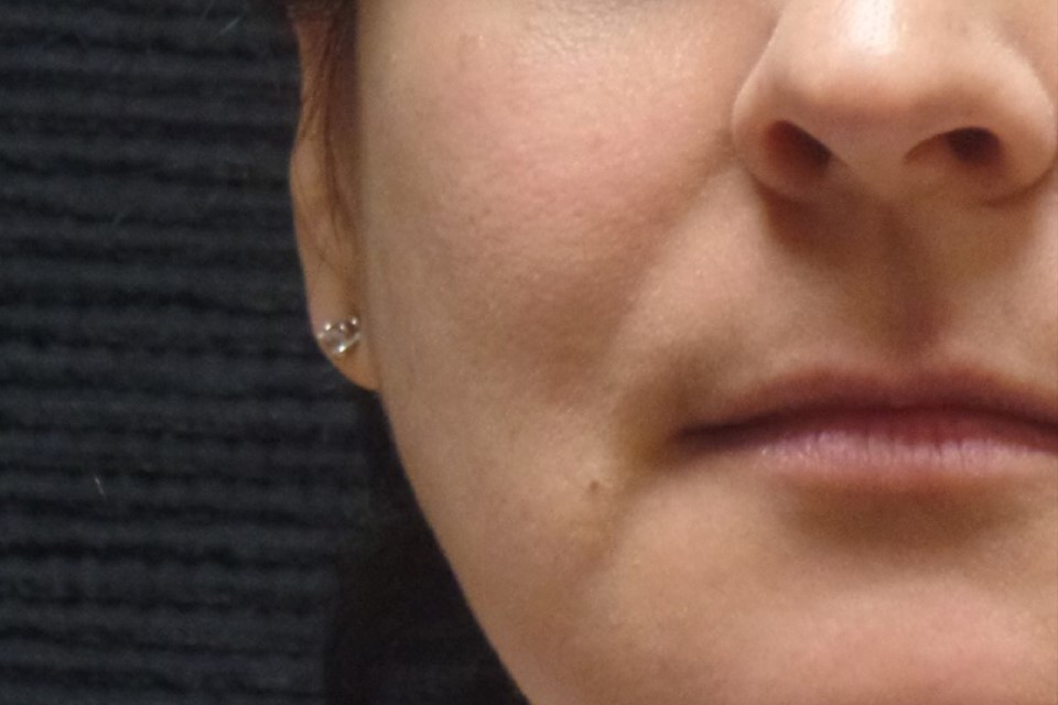 Patient #48319: Vollure Before Image