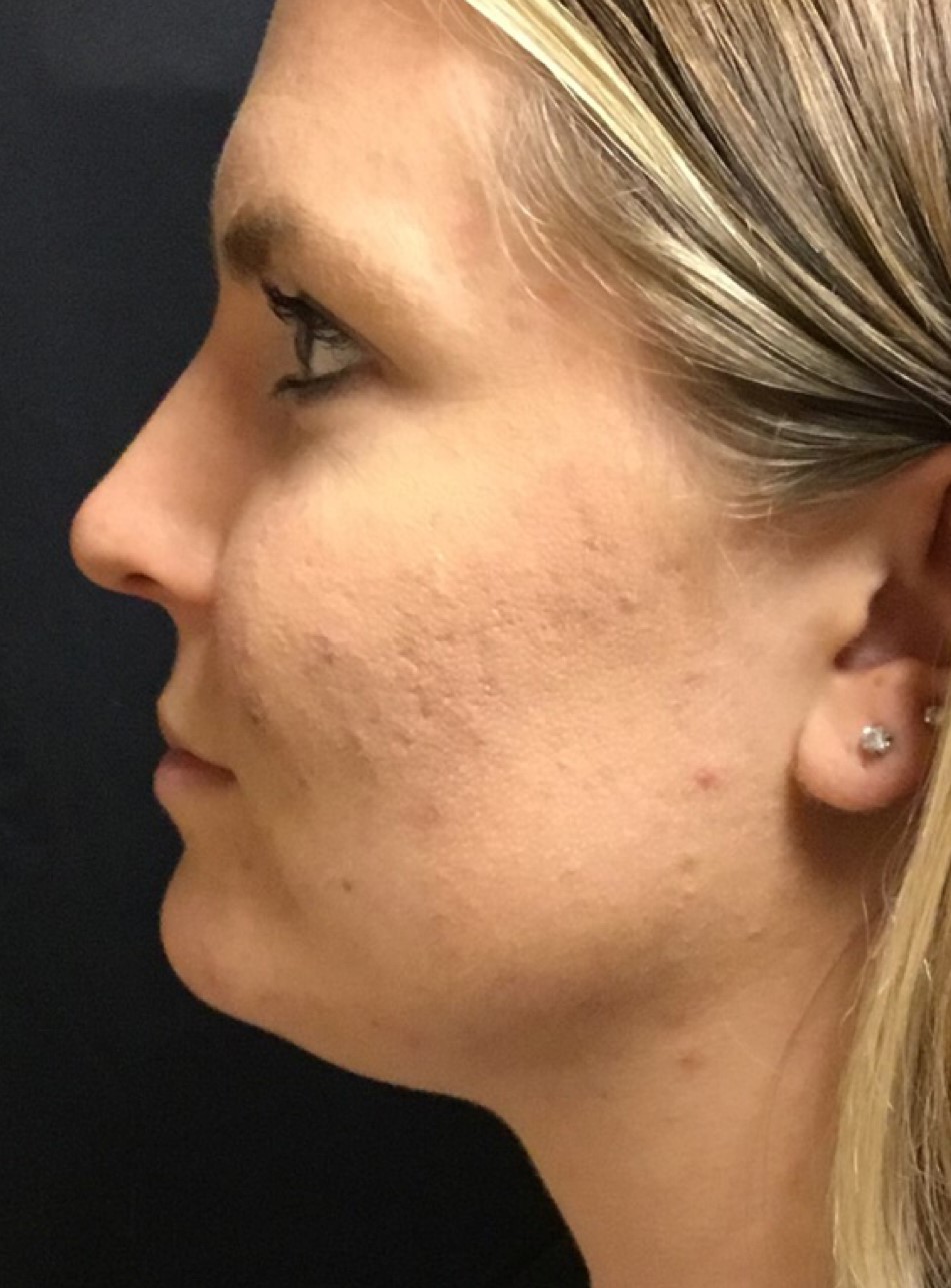 Patient #80222-2: Microneedling for Acne Scarring Before Image