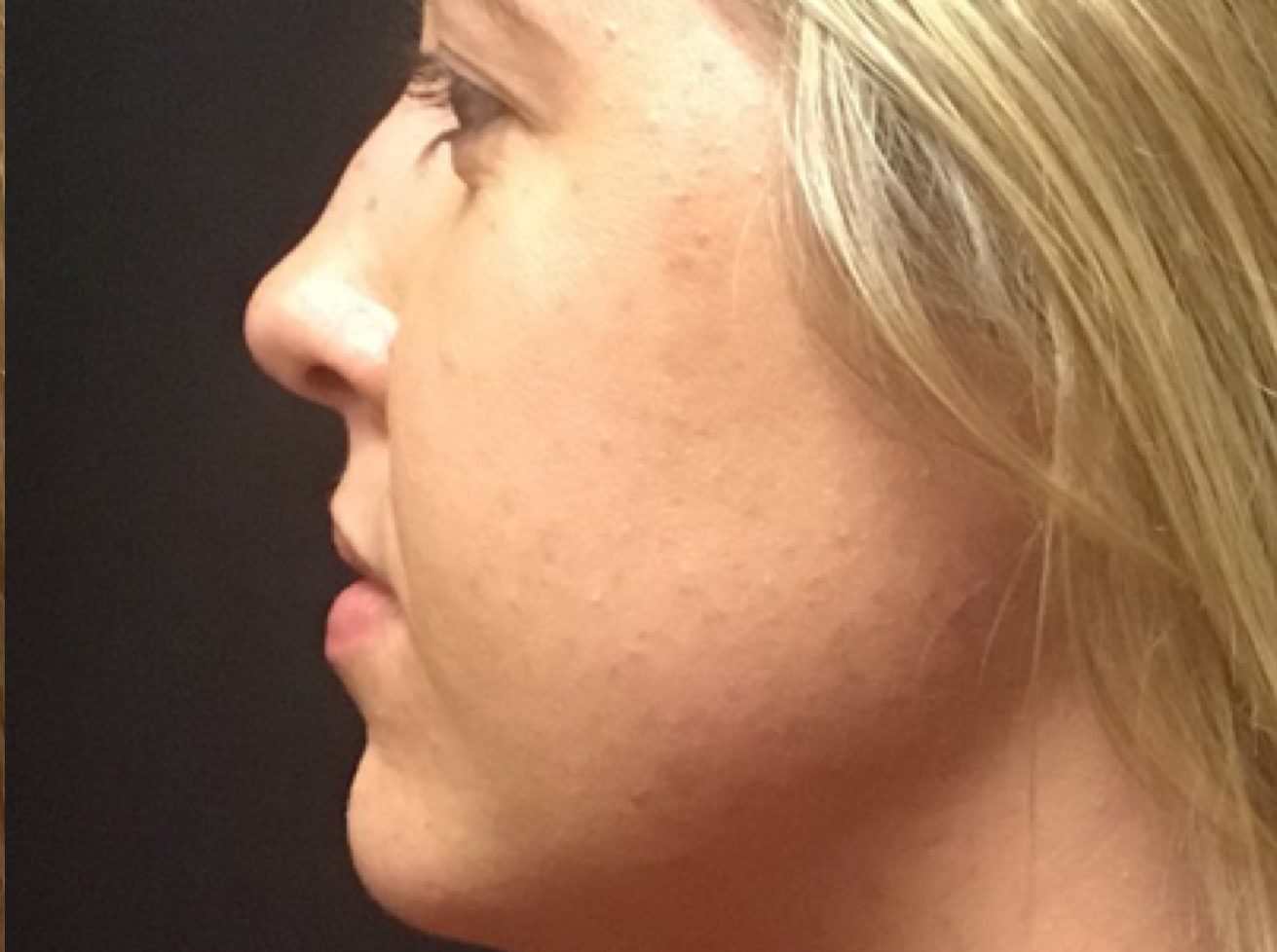 Patient #39130: Chemical Peel After Image