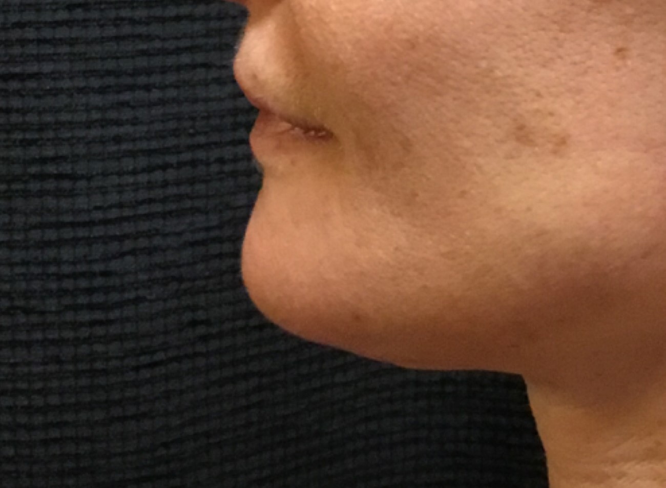 Patient #49658: Kybella After Image