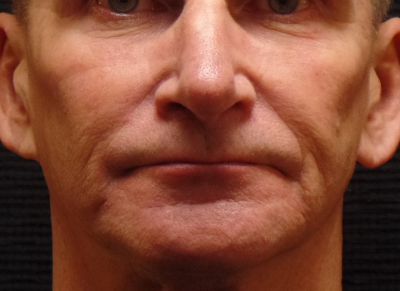 Patient #74935-1: IPL for Brown Spots After Image