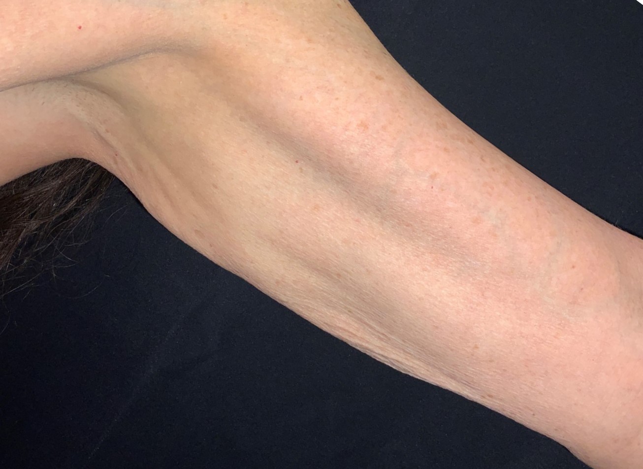 Patient #44674-1: Skin Tightening with Radiofrequency After Image