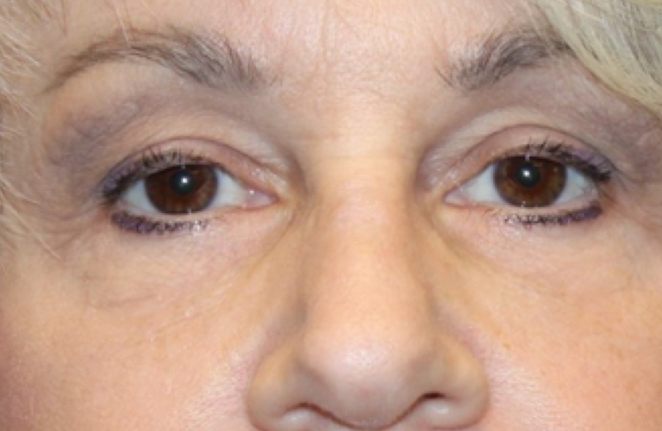 Patient #67047:  Voluma and Volbella After Image