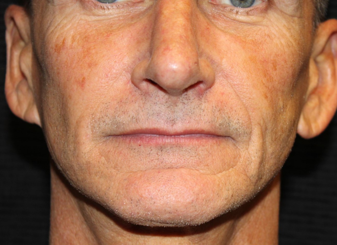 Patient #74935-1: IPL for Brown Spots Before Image