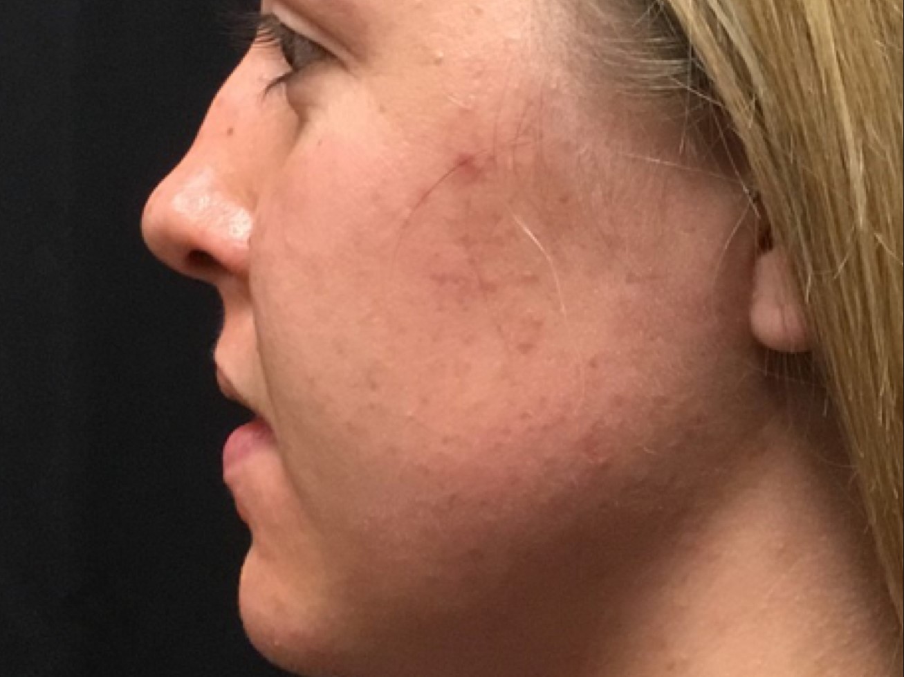 Patient #39130: Chemical Peel Before Image