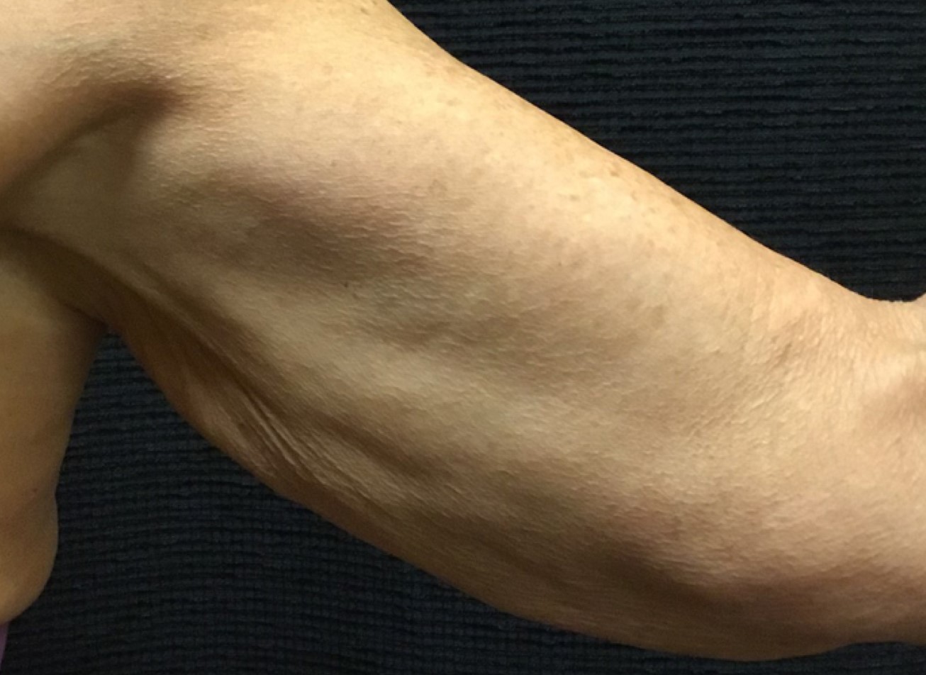 Patient #44674-1: Skin Tightening with Radiofrequency Before Image
