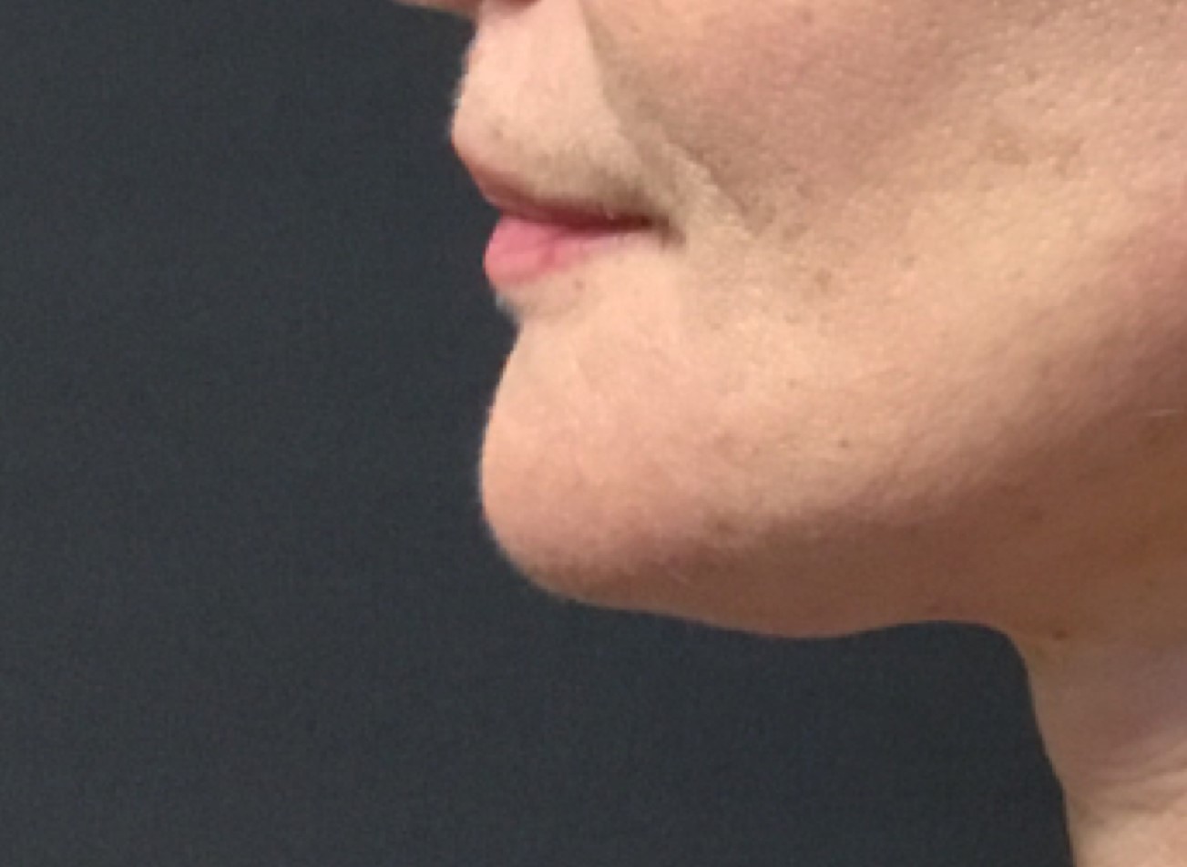 Patient #49658: Kybella Before Image