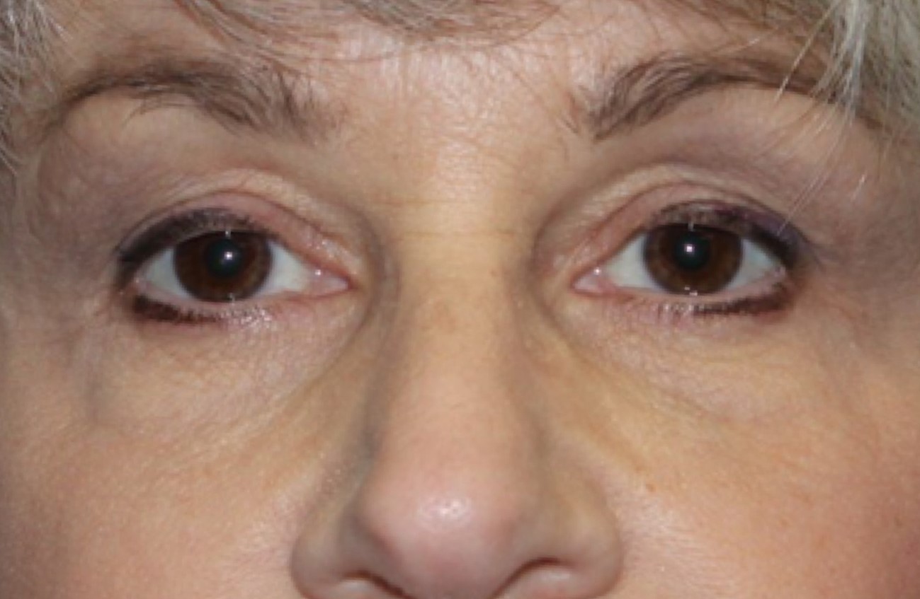 Patient #67047:  Voluma and Volbella Before Image