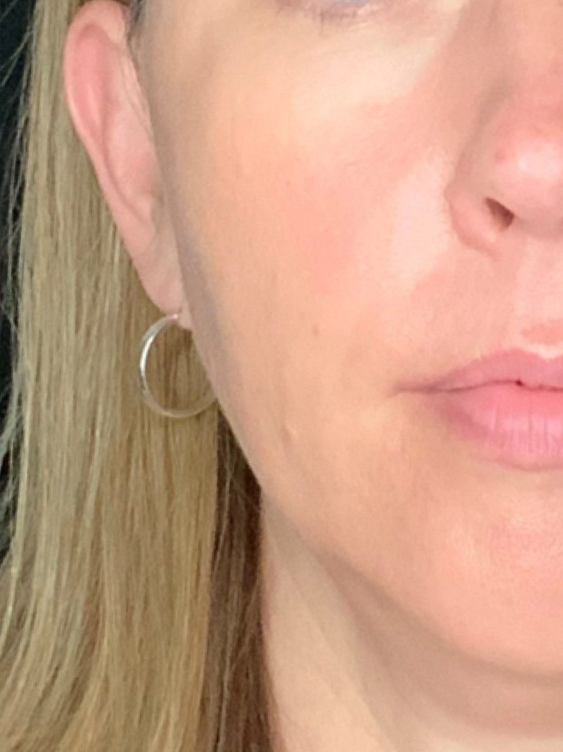 Patient #75111: 3 For Me Refresh After Image