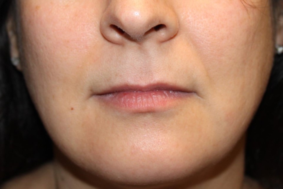 Patient #48319: Vollure After Image