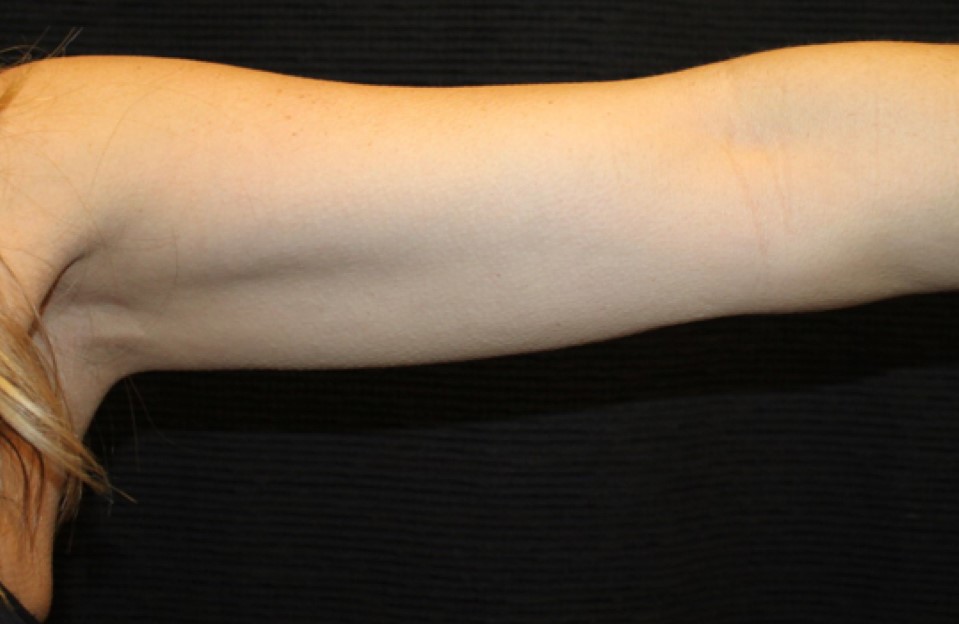 Patient #95479: CoolSculpting After Image