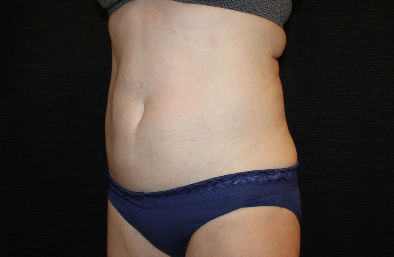 Patient #58820: CoolSculpting After Image