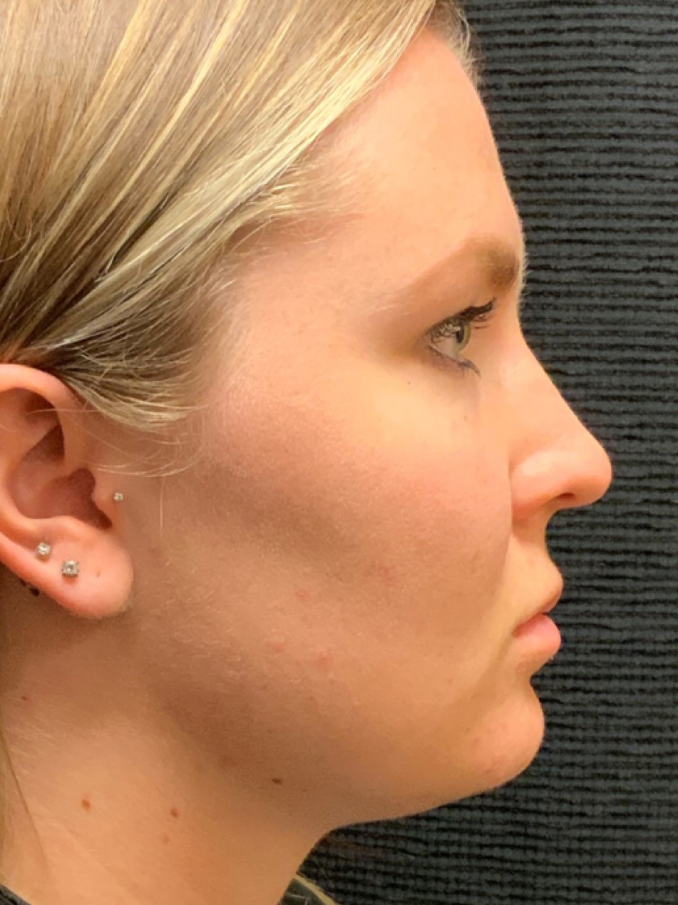 Patient #80222-2: Microneedling for Acne Scarring After Image
