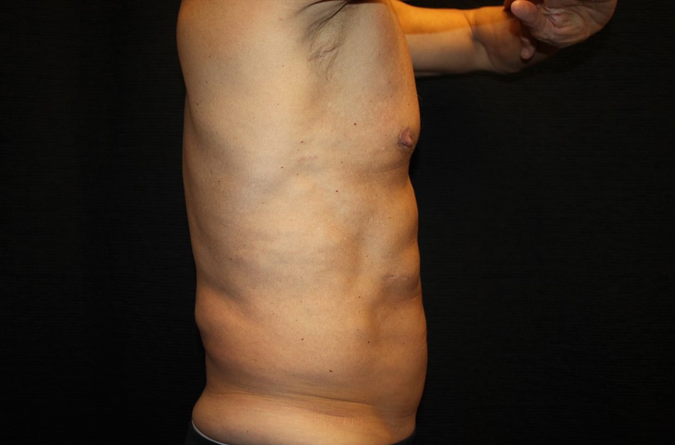 Patient #65350: CoolSculpting After Image