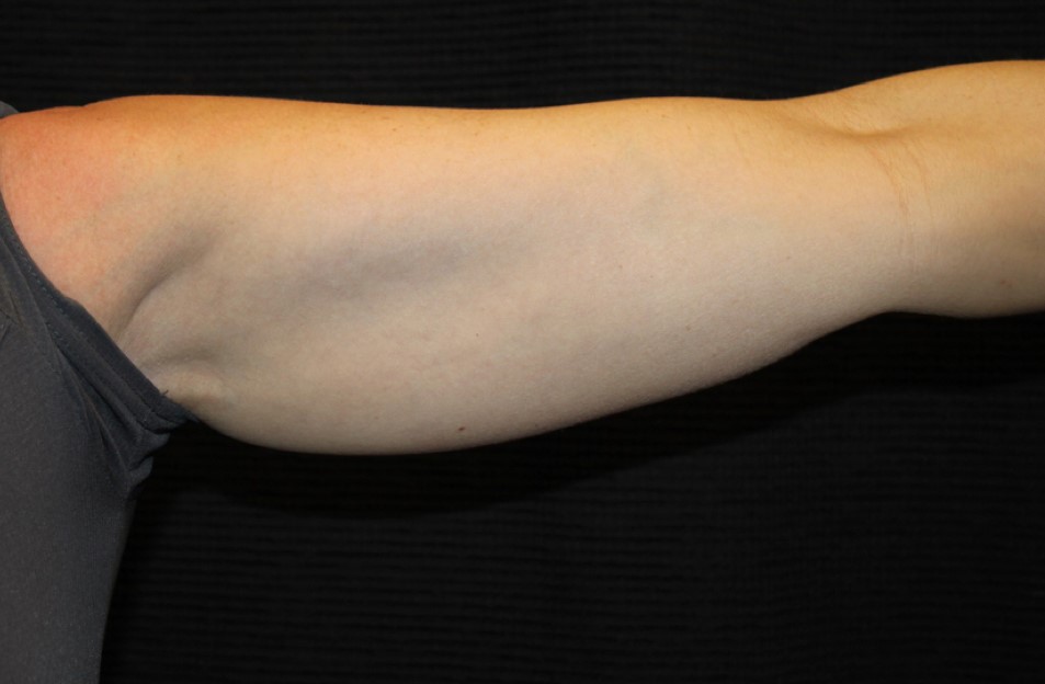 Patient #95479: CoolSculpting Before Image