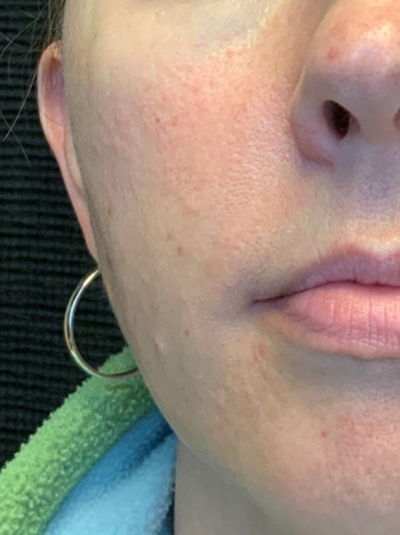 Patient #75111: 3 For Me Refresh Before Image