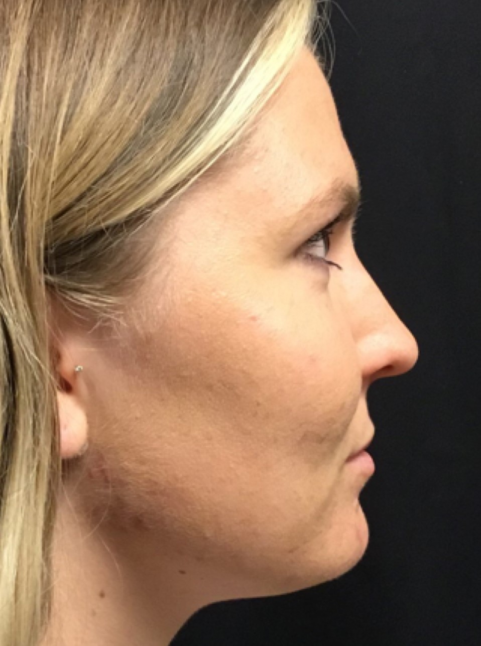 Patient #80222-2: Microneedling for Acne Scarring Before Image