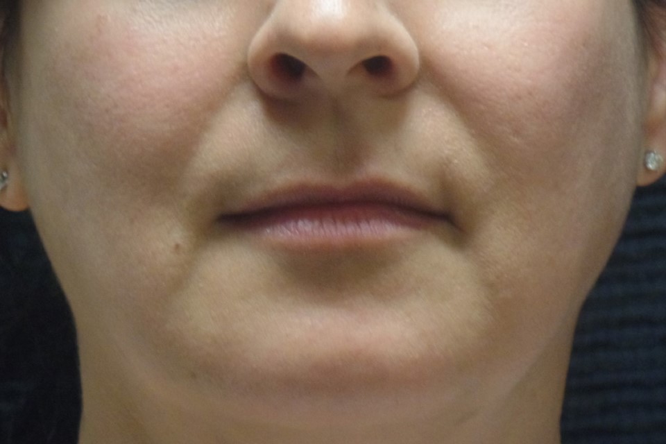 Patient #48319: Vollure Before Image