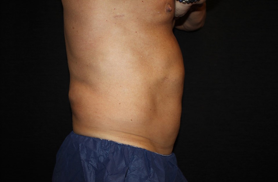 Patient #65350: CoolSculpting Before Image