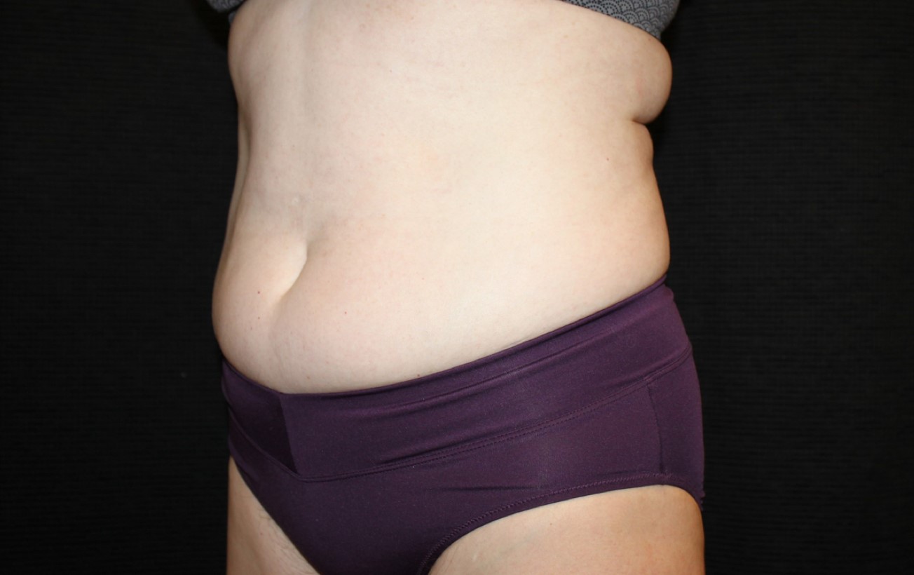 Patient #58820: CoolSculpting Before Image