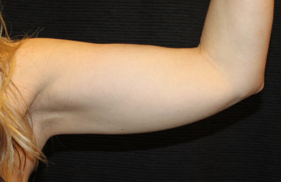 Patient #95479: CoolSculpting After Image