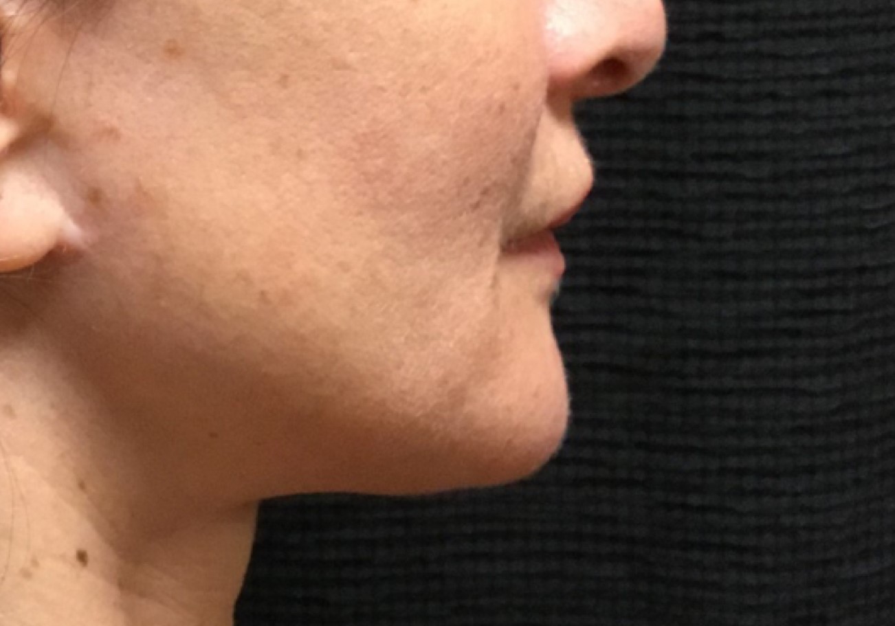 Patient #49658: Kybella After Image