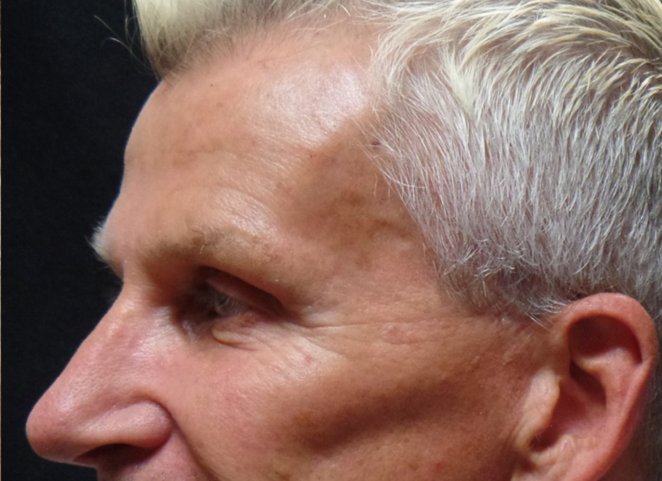 Patient #74935-1: IPL for Brown Spots After Image