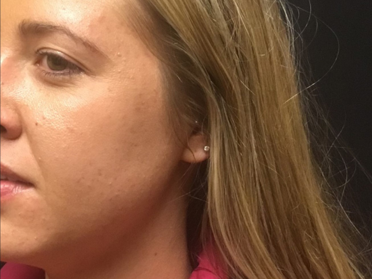 Patient #39130: Chemical Peel After Image