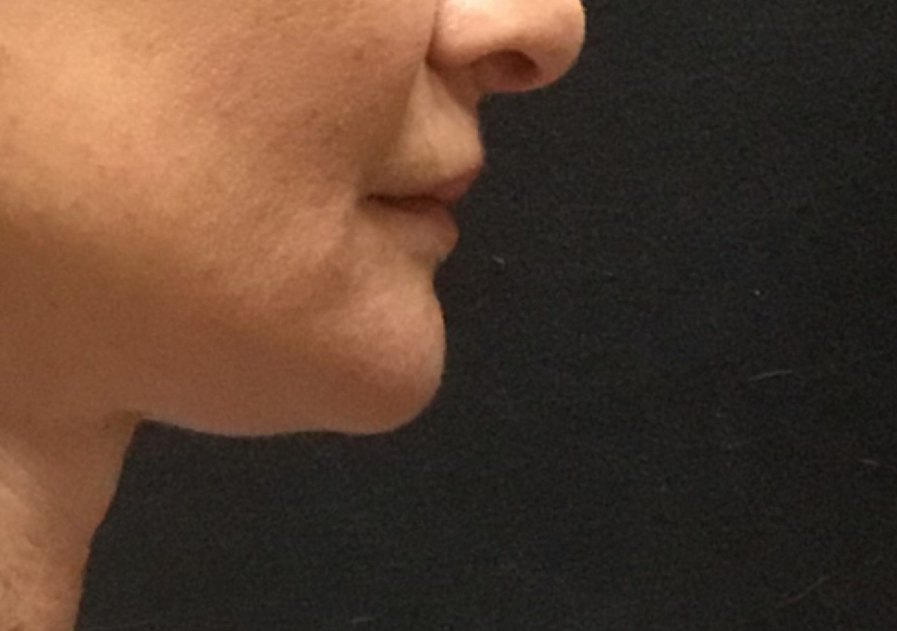 Patient #49658: Kybella Before Image