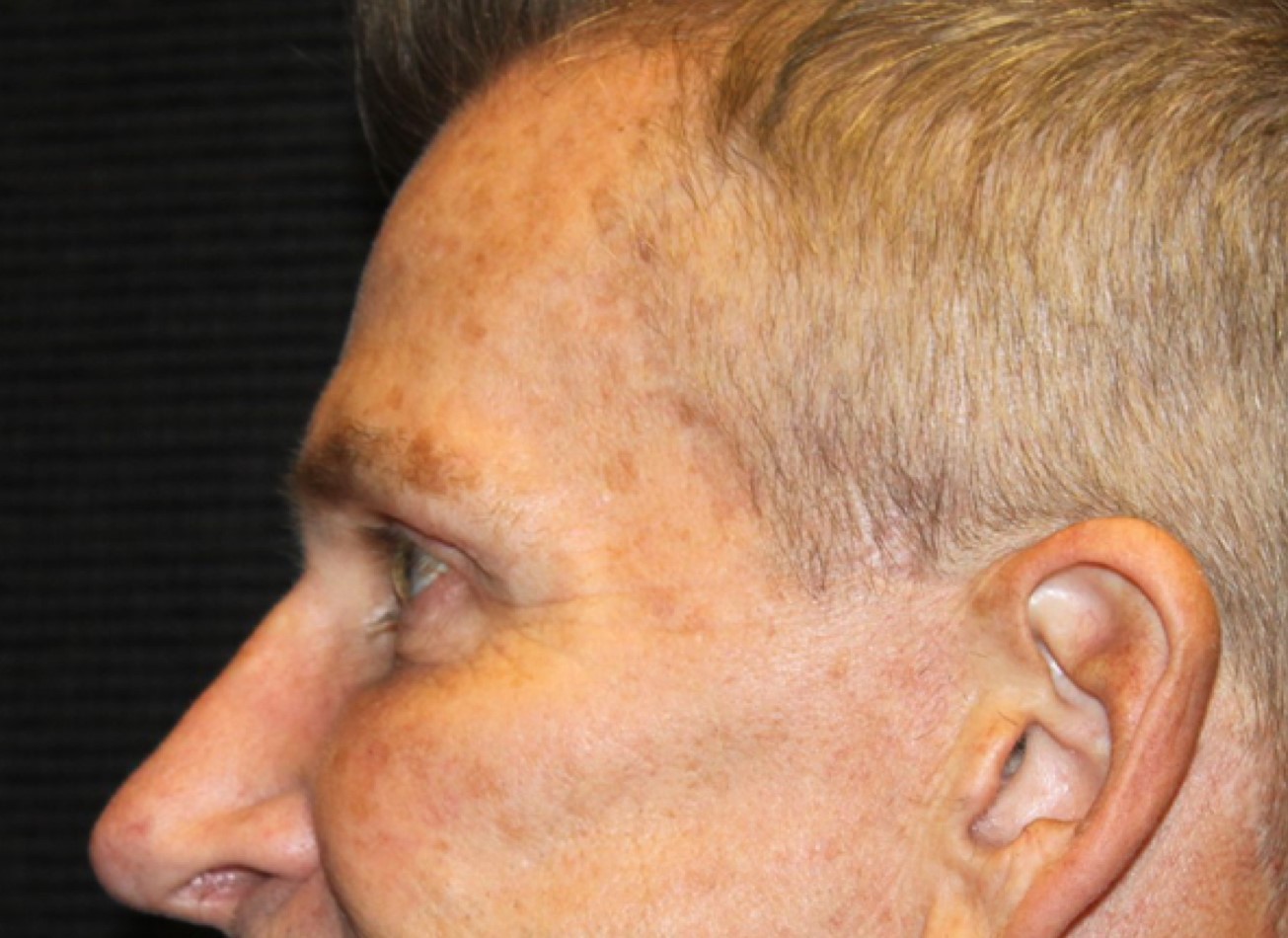 Patient #74935-1: IPL for Brown Spots Before Image