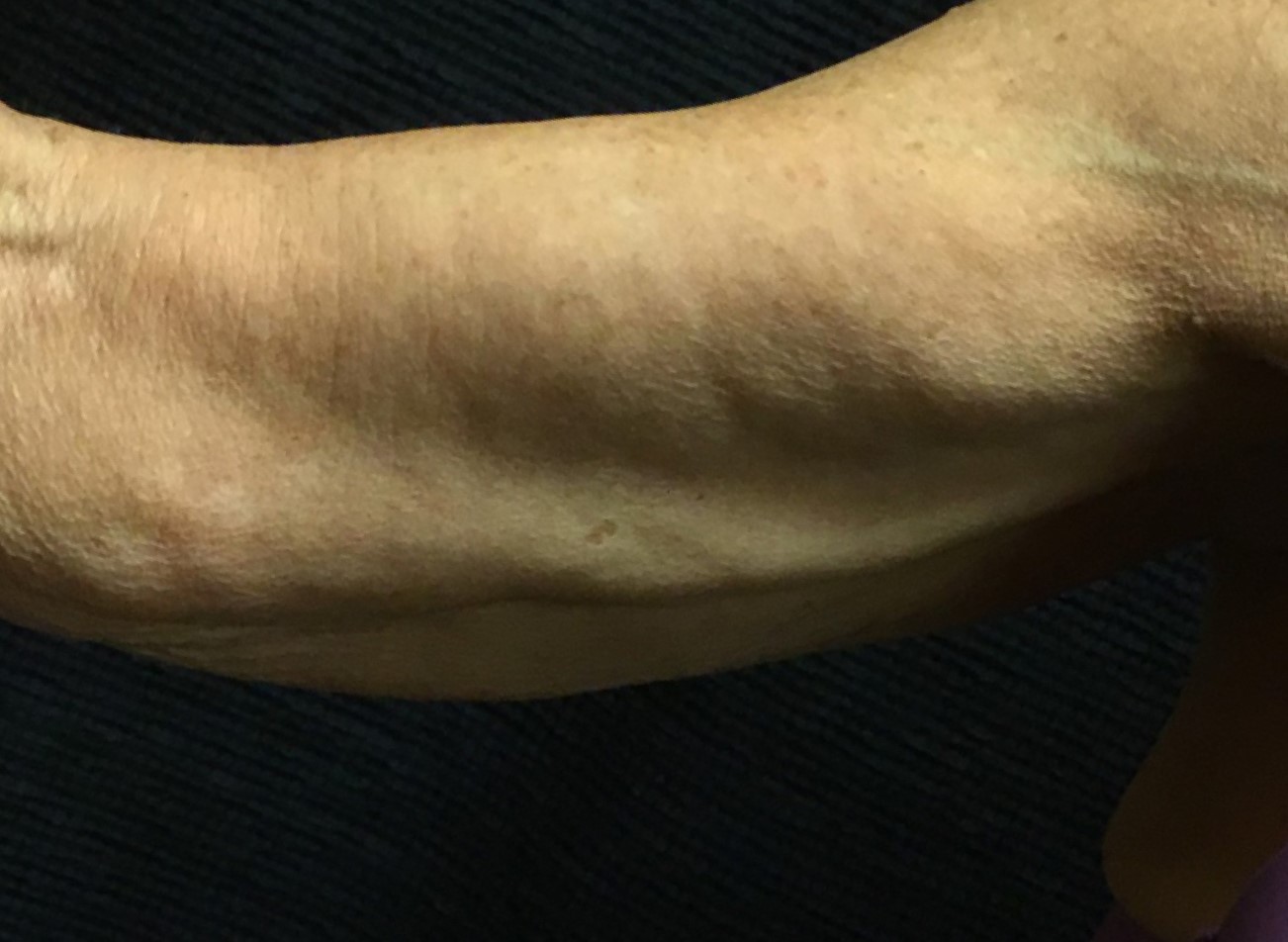 Patient #44674-1: Skin Tightening with Radiofrequency Before Image
