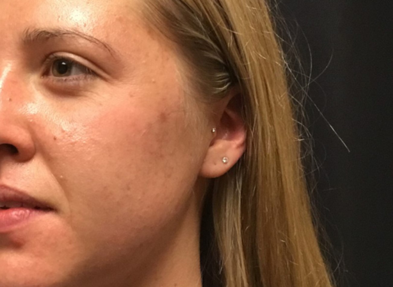 Patient #39130: Chemical Peel Before Image