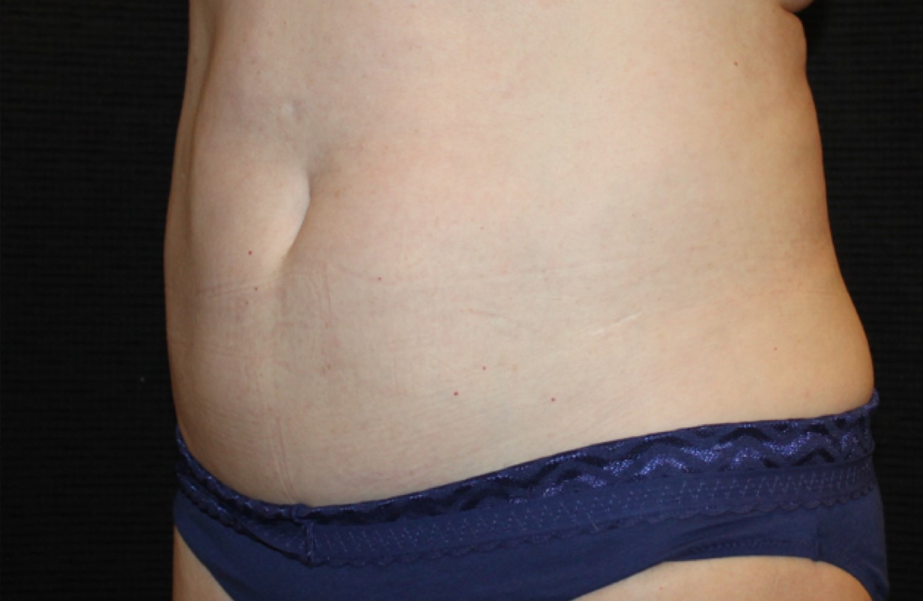 Patient #58820: CoolSculpting After Image