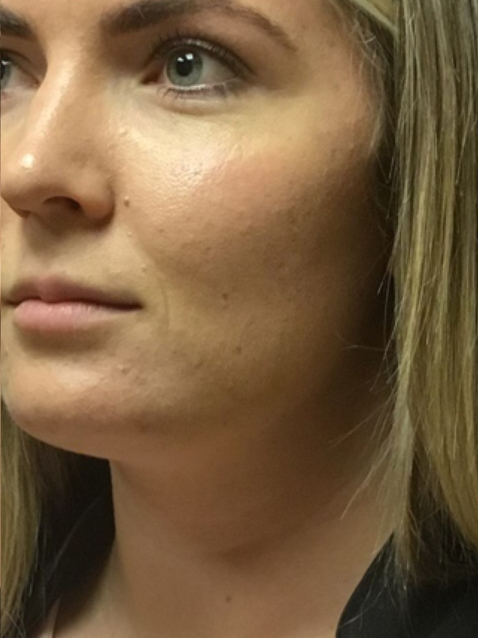 Patient #80222-2: Microneedling for Acne Scarring After Image