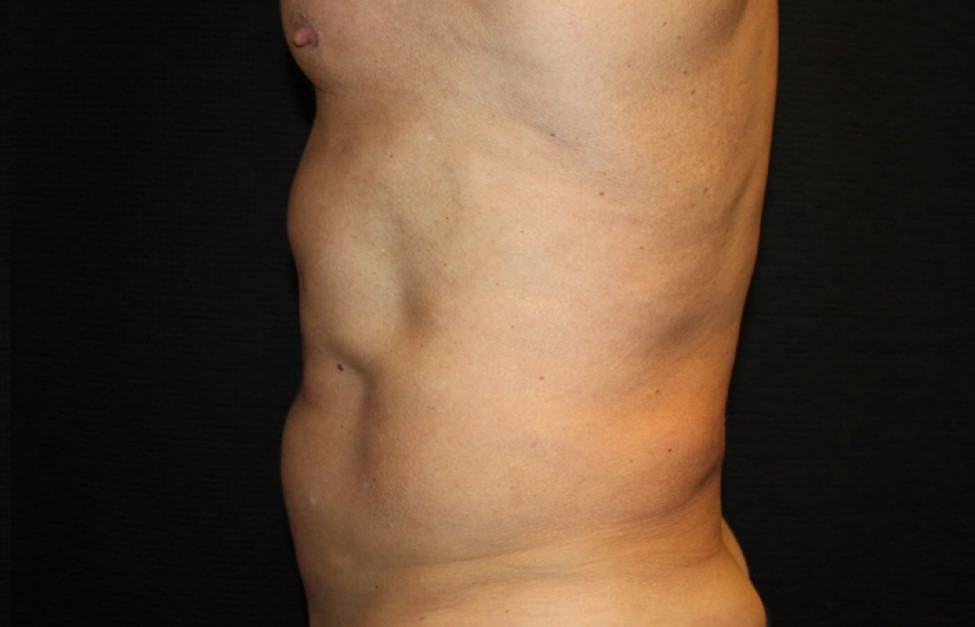 Patient #65350: CoolSculpting After Image