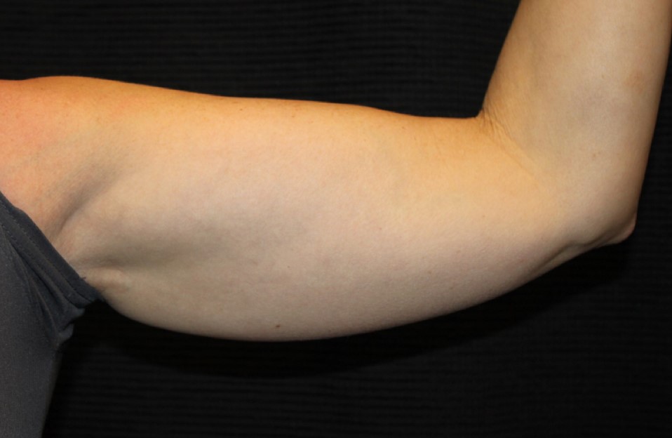 Patient #95479: CoolSculpting Before Image